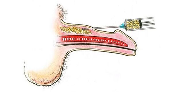 Injections of hyaluronic acid in the course of a member to increase it